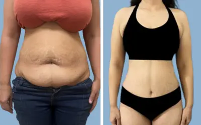 Before and After